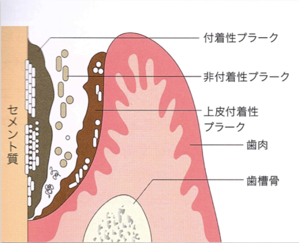 口の中にいる悪魔 ライフ デンタル オフィス 院長ブログ